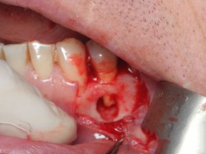 Как проводится удаление кисты зуба