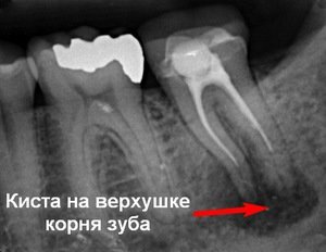 Лечение кисты на зубе начинается с диагностики при помощи рентгена