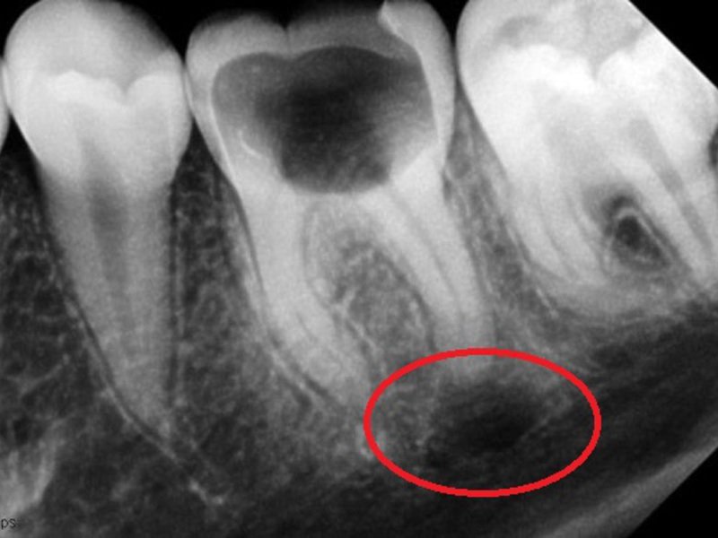Рентген кисты зуба покажет проблемную область