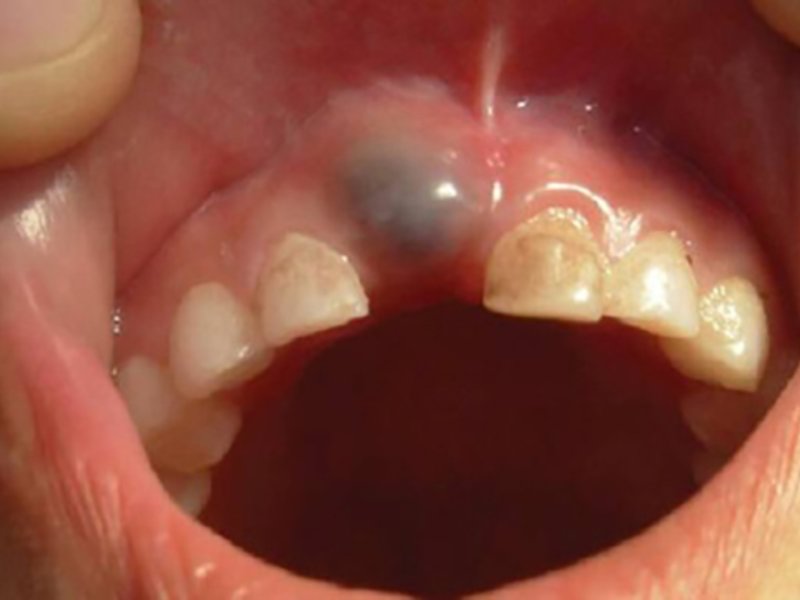 Киста зуба не лечится народными методами, здесь нужна помощь стоматолога-хирурга