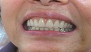 Особенности съемных протезов и имплантации зубов