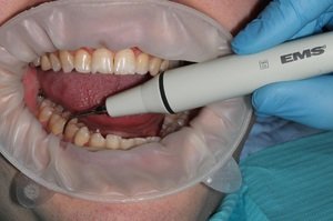 Цена процедуры по удалению зубных камней