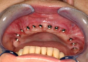Зубные импланты без операции