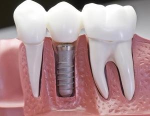 Имплантология зубов - штифт и протез во рту