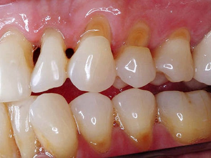 Симптомы пришеечного кариеса на зубах