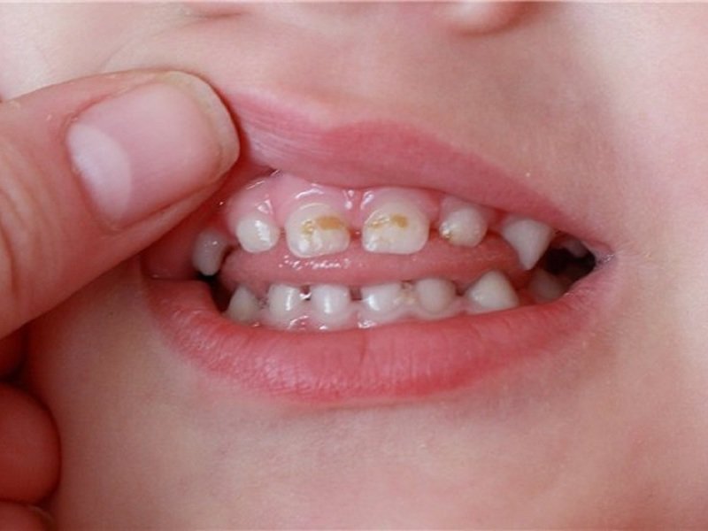 Особенности бутылочного кариеса молочных зубов