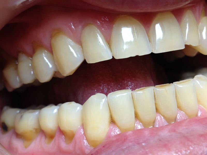 Описание поражённых зубов прикорневым кариесом