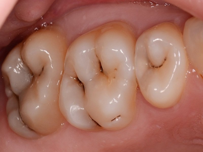 Особенности поражения зубов фиссурным кариесом
