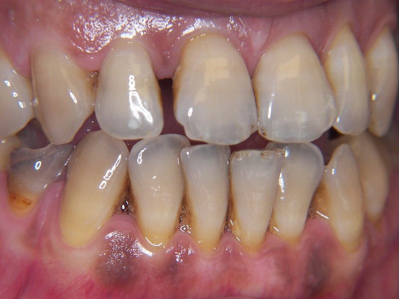 Описание дегенеративных процессов при кариесе зубов