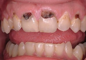 Кариес: что это такое, причины и симптомы, фото поражённых зубов