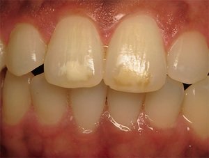 Формы зубного кариеса и их характеристики