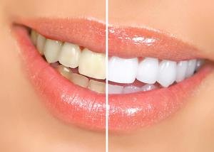 Отбеливание зубов - как меняется ваша улыбка