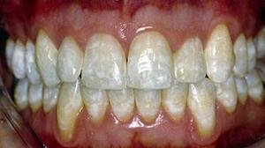 Описание причин ломоты в зубах