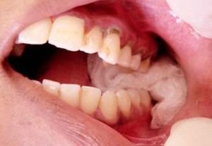 Что следует после удаления зуба