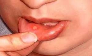 Особенности лечения афтозного стоматита у детей