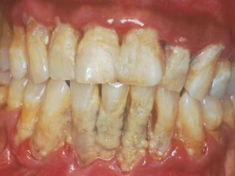 Методы лечения зубного камня
