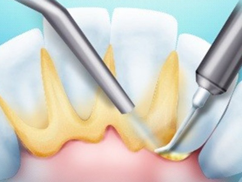 Процедура удаления зубного камня