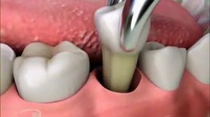 Сколько может заживать десна после удаления зуба