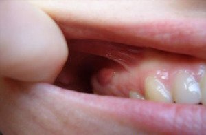 Причины образования кисты зуба