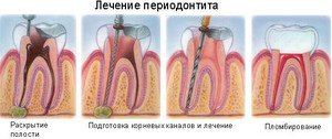 Порядок лечения периодонтита Как лечить периодонтит