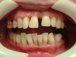 Профилактика расшатывания зубов