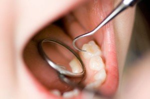 Как ухаживать за зубами во избежании периодонтита