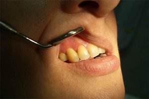 Что такое киста зуба