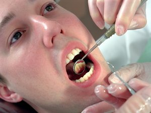 Как вылечить гранулему зуба
