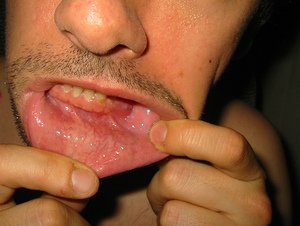Как лечить абсцесс зуба