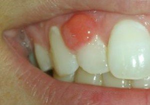 Причины абсцесса зубов