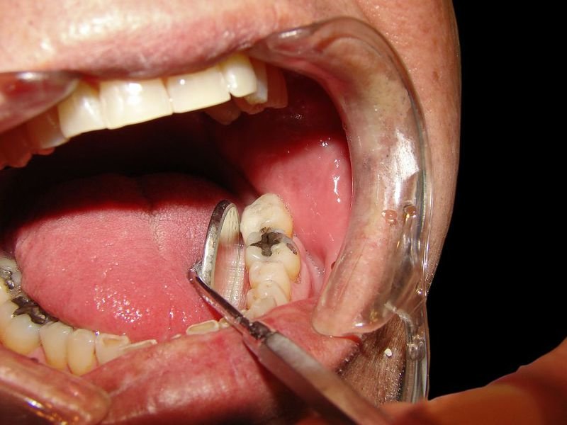 Как лечить абсцесс зуба