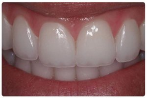 Люминиры на зубы и их стоимость, фото до и после установки