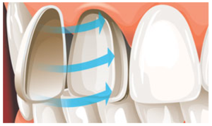 Проблемы внешнего вида зубов решают виниры