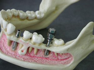 Протезирование зубов перед винирами