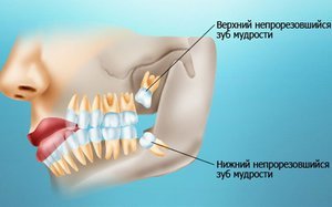 Сколько стоит удалить зуб в стоматологии