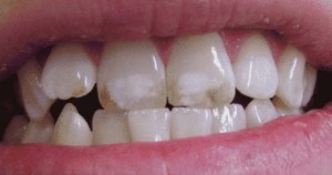Почему нужно избавляться от белого пятна на зубе у ребенка