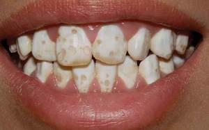 Как выглядит гипоплазия зубов