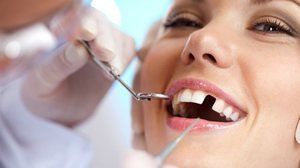 Процесс установки зубных имплантов