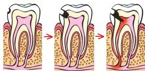 Пульпит зуба — что это такое и какие есть разновидности