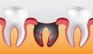 Альвеолит - удаление лунки после воспаления зуба