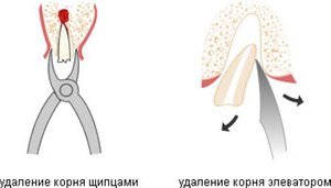 Инструменты для удаления корня зуба