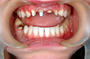 Протезирование зубов с помощью имплантов