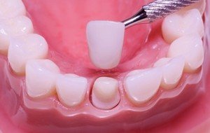 Какие зубные коронки лучше ставить на зубы?