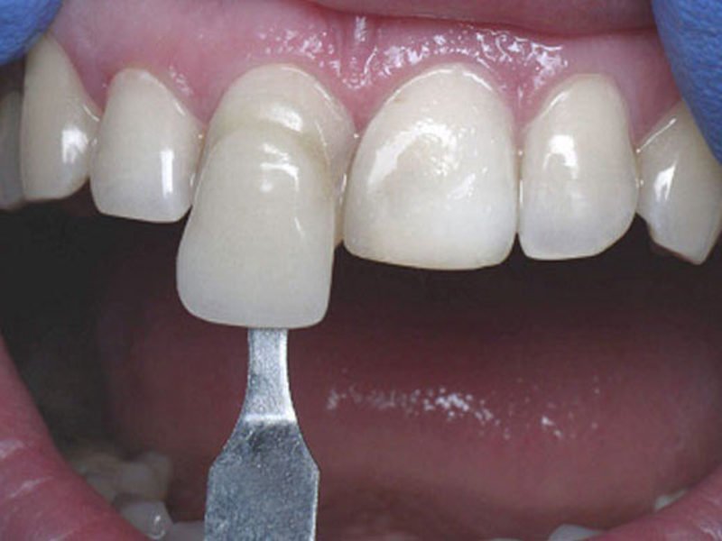 Необходимость стачивания зуба под установку коронки