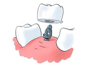 Все, что нужно знать пациенту о базальной имплантации зубов