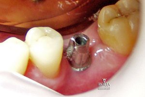 Противопоказания для стоматологической имплантации 