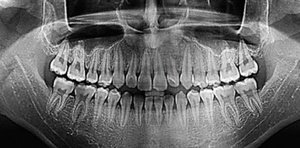 Показания для стоматологической имплантации