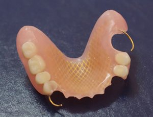 Частичный зубной протез