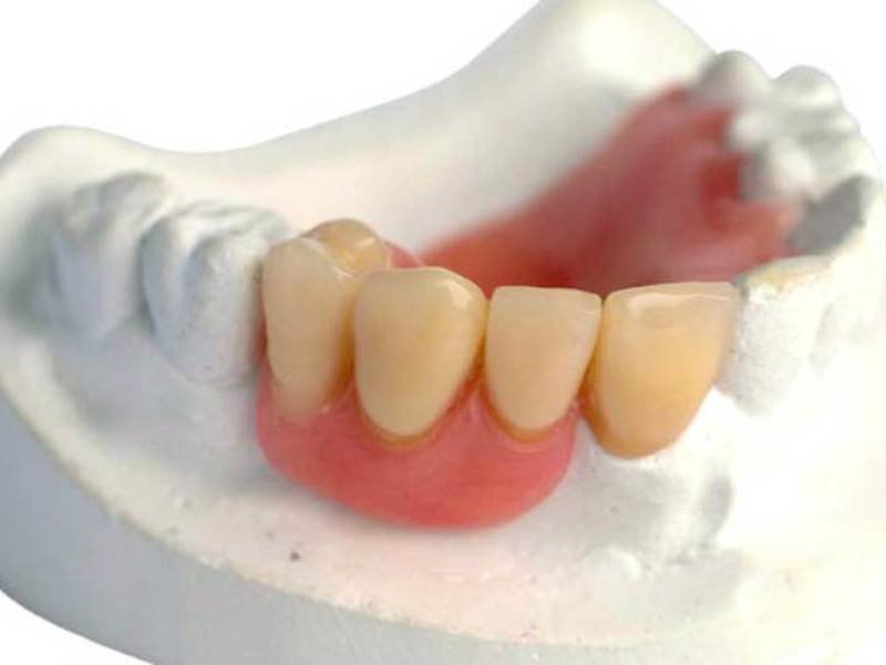 Съемный акриловый зубной протез