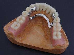 Отзывы о бюгельных зубных протезах